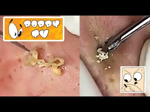 Large Closed Comedones - Whiteheads Extraction