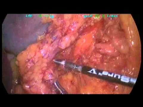 Partial Spleen Resection With A Laparoscipic Approach Due To A Cyst Presence  