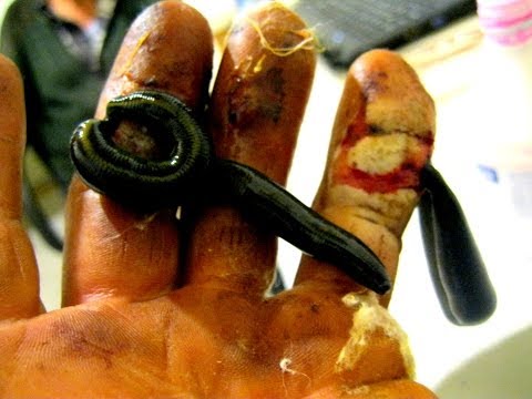 Воспаление лимфоузлов на шее с левой стороны причины и лечение Забирают ли в армию при остеохондрозе