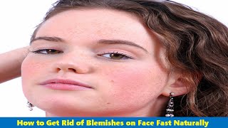 How to Get Rid of Blemishes on Your Face and Skin Fast Overnight Naturally