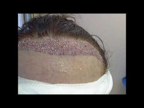 Excellent female hair transplant repair in Washington by Dr. Lindsey | McLean | VA thumbnail