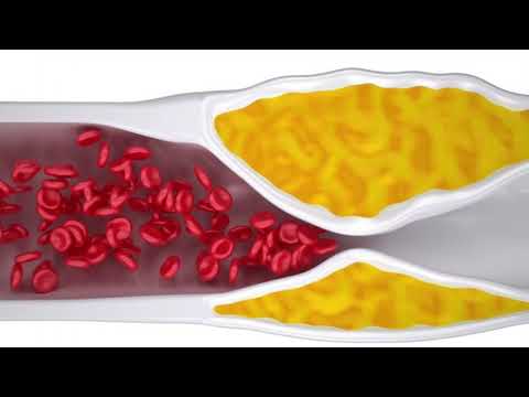 Shenjat që tregojnë se keni arterie të bllokuara