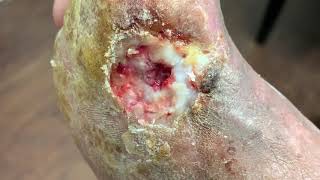 EXTREME GRAPHIC CONTENT: LEGS AT RISK FOR LOSS / DIABETIC ULCERS WITH BONE INFECTION 😢😢😢
