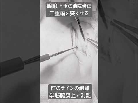 医学科 二重幅を狭くする剥離の実際