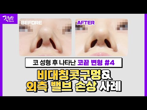 [실제 사례] 코 성형 후 비대칭 콧구멍 & 외측 밸브 손상 사례!｜원인 및 해결 방법