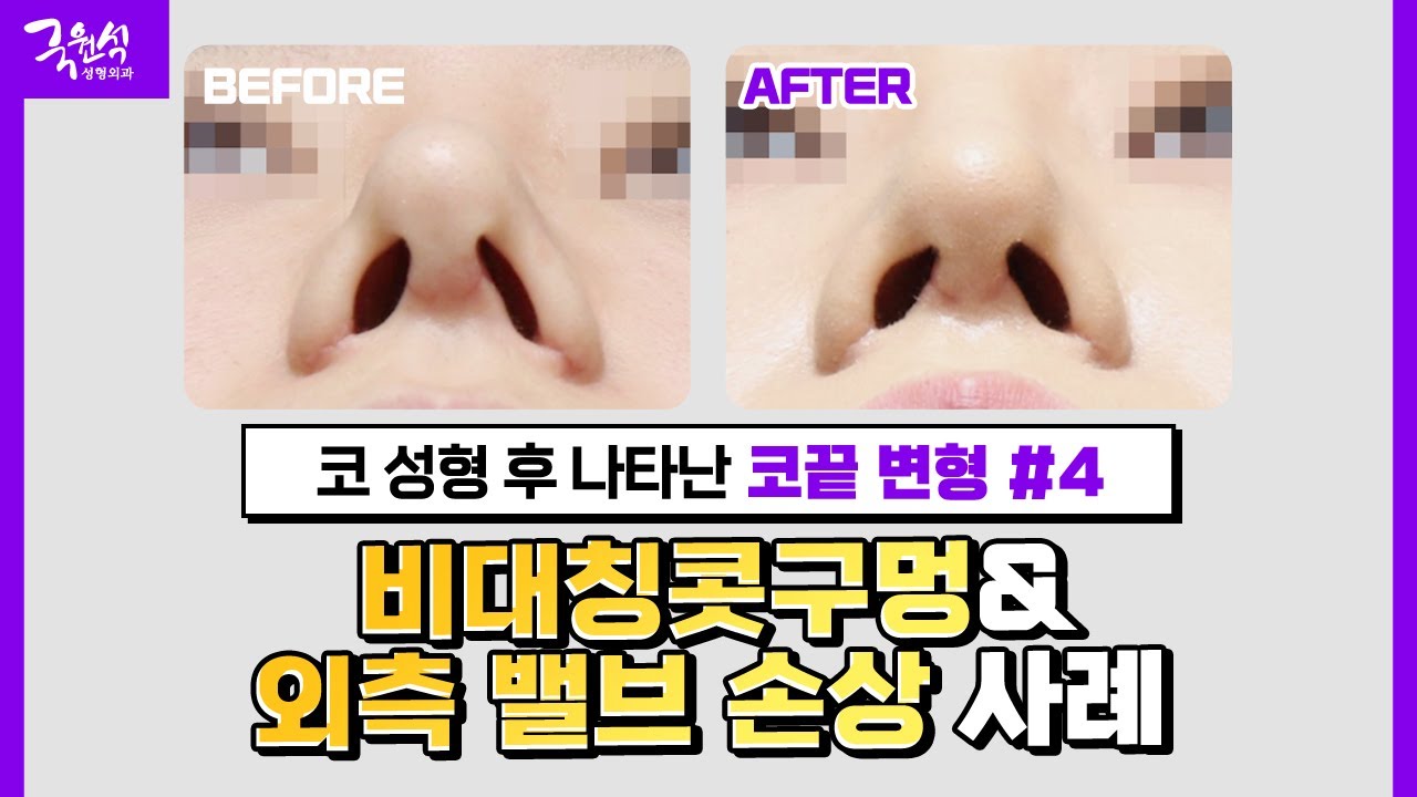 [실제 사례] 코 성형 후 비대칭 콧구멍 & 외측 밸브 손상 사례!｜원인 및 해결 방법 썸네일