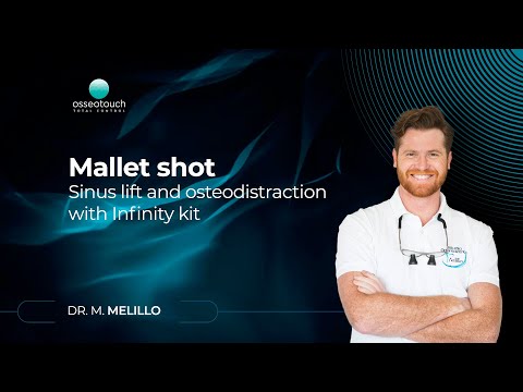 Webinar Dr. Melillo — Sinus lift and osteodistraction with Infinity kit