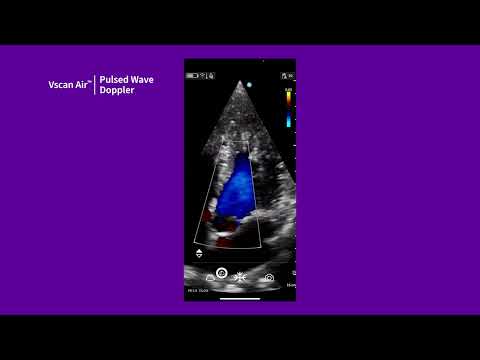 Vscan Air™ Tutorials | Pulsed Wave Doppler