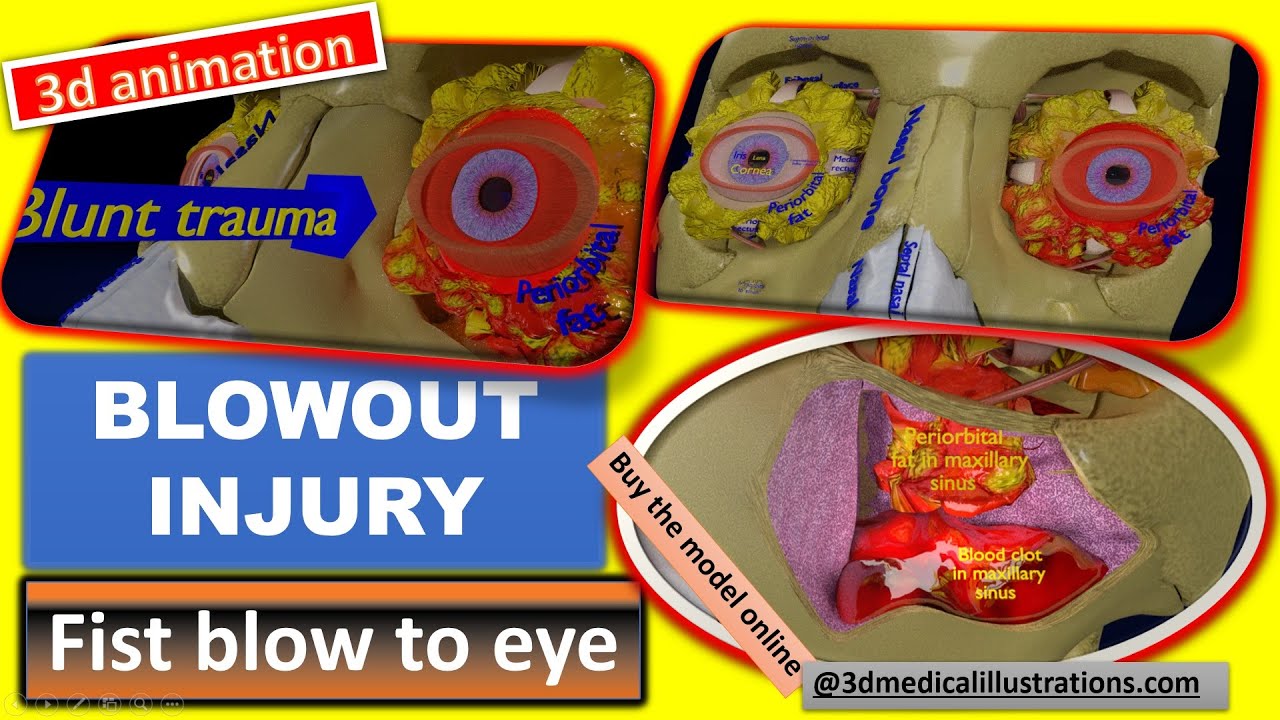 Eye blow out injury 3d 3D Model