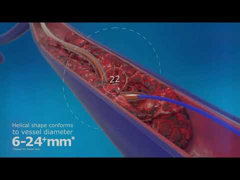 Cateter de trombectomia Angiojet ™ ZelantEdvt - MedCia - Boston Scientific