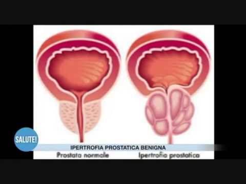 Trattamento getto di prostatite È possibile curare la prostatite cronica