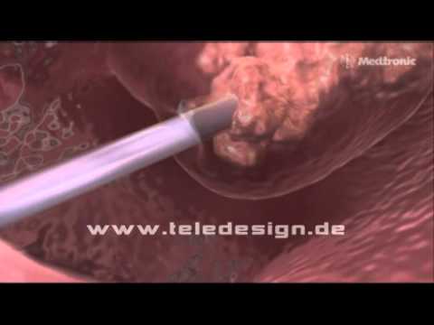 HNO 017 Nasen-Polypen Entfernung  - PAL 16:9/ HNO 017 Removal of nasal polyps   - PAL 16:9