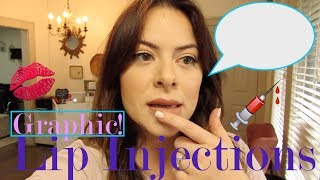 Watch Me Get Lip Injections