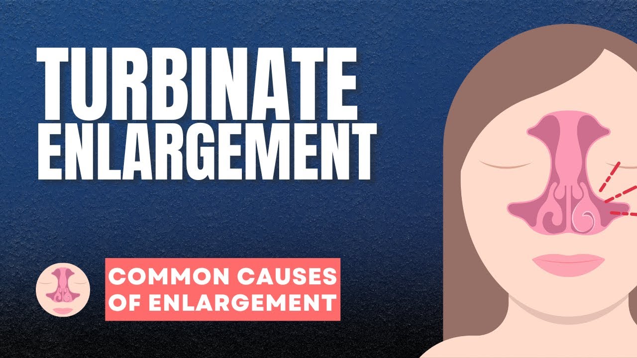 What do nasal turbinates look like with allergies? More REF