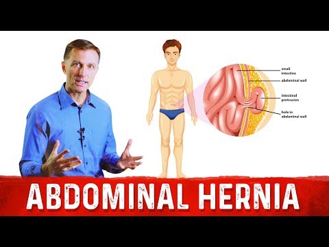 What Causes An Abdominal Hernia? – Dr.Berg on Hernia Causes