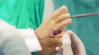 Tratamiento Quirúrgico del Neuroma de Morton