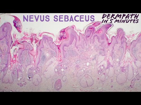Nevus sebaceus: Dermpath in 5 Minutes (pathology dermatology dermatopathology)