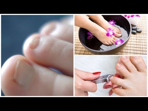 Die Behandlung gribka auf dem Bein vom Salz Das Antibiotikum für die Behandlung gribka des Nagels