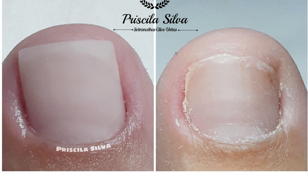 Reconstrução das unhas do pé com gel...