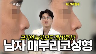 꺼진 미간과 매부리 동시 해결! 실리콘을 이용한 남자 코성형 1년 3개월 경과 매부리코성형 케이스, [첫단추 260109]