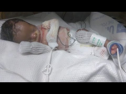 Le bébé né sans peau 😱quitte l'hôpital après avoir reçu un miracle. Santé Parfaite & Divertissement Video