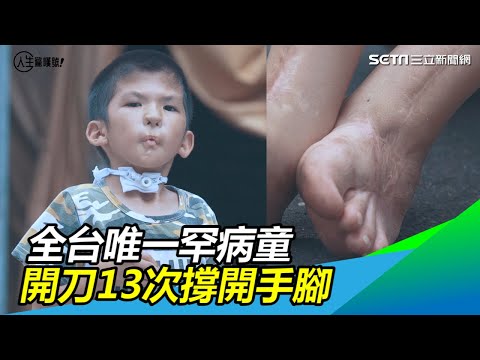 , title : '愛不罕見／全台唯一罕病男童　開刀13次才把手腳指撐開｜三立新聞網SETN.com'