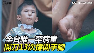 全台唯一罕病男童　開刀13次把手腳指撐開