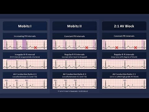 Second Degree AV Block ECG