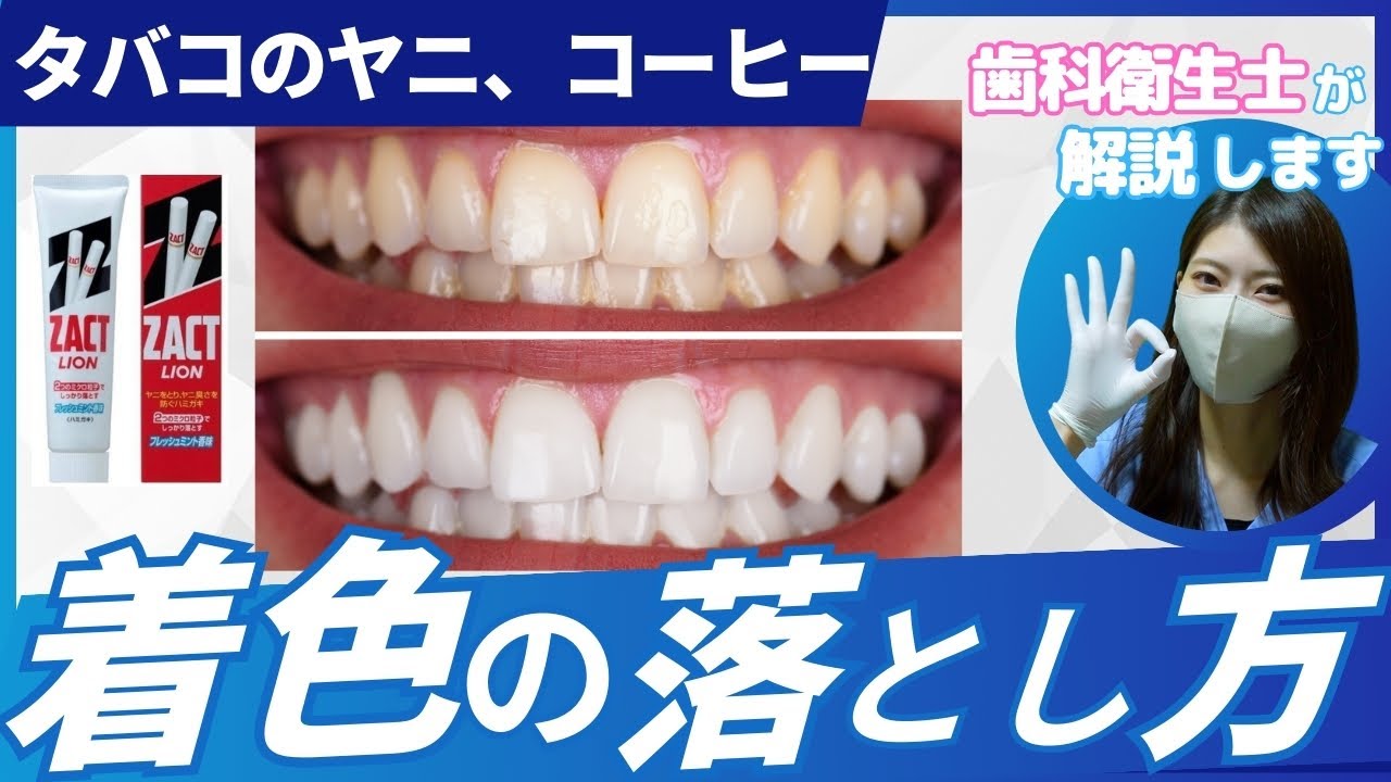 【解説】歯の黄ばみ、着色の落とし方！