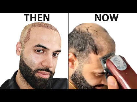 I Shaved My HEAD BALD 4 Years After Hair Transplant |...