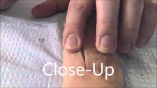 How to Close a Wound in Seconds With Surgical Staples