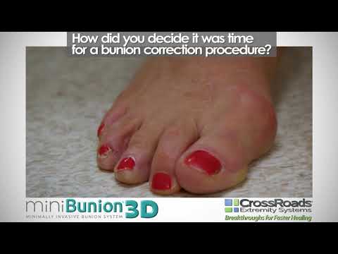 miniBunion® 3D FAQs "How did you decide it was time for a bunion correction procedure?"