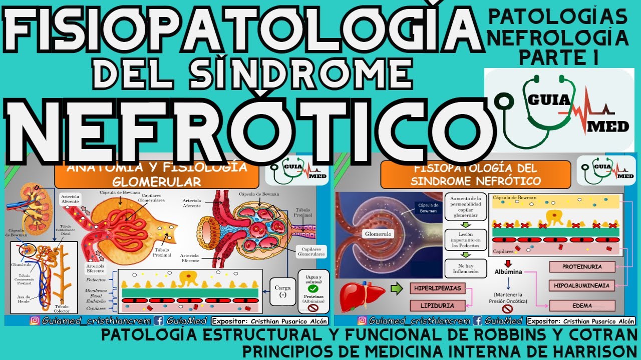 SÍNDROME NEFRÓTICO FISIOPATOLOGÍA | GuiaMed