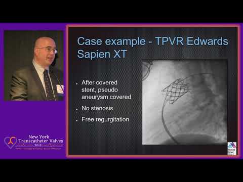 TAVR: Update on the Progress and Outcomes - Dr. Barry Love