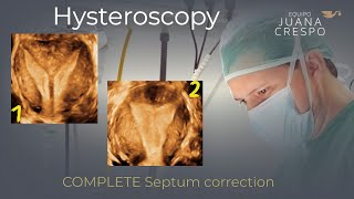 Complete uterine septum