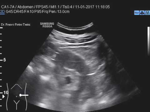 Un dolore fastidioso nel piccolo della schiena su ogni lato Qual è osteocondrosi della lombari