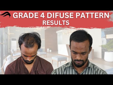 Hair Transplant In Chennai | Best Cost Results &...