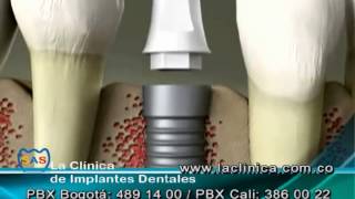 Implantes Dentales - Clínica SAS