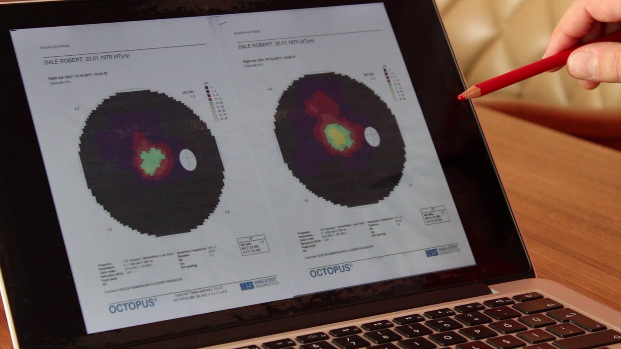 Retinitis Pigmentosa Treatment - November 2017-new patient results - FIRATLI CLINIC