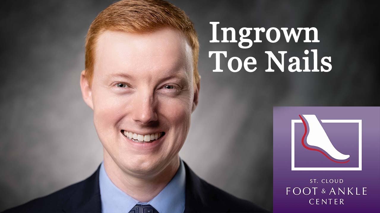 How to Treat Ingrown Toe Nails?