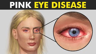 How Conjunctivitis Damages The Eye? (Pink Eye Disease)
