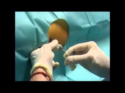 comment guerir une bursite de la hanche