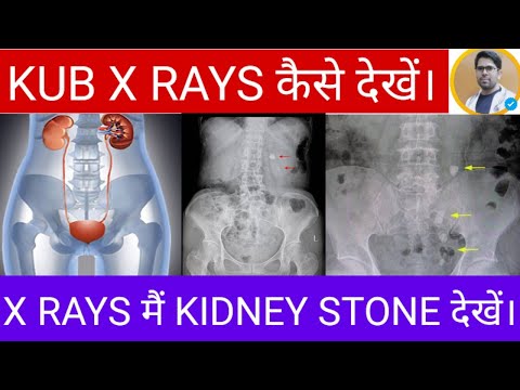 KUB Lernen Sie, Röntgenbilder zu lesen/Wie sehen Nierensteine ​​im Röntgenbild aus/Nierenstein-Rö...