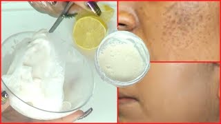 IT REMOVES DARK SPOTS QUICKLY AND NATURALLY, GET RID OF SPOTS AND SCARS IN JUST 7 DAYS Khichi Beauty