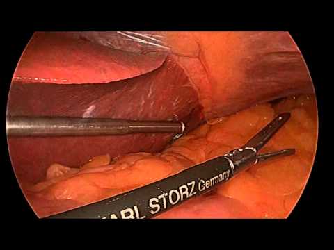 EndoLift for Liver Retraction & EndoGrab for Greater Omentum Retraction During Gastric Banding