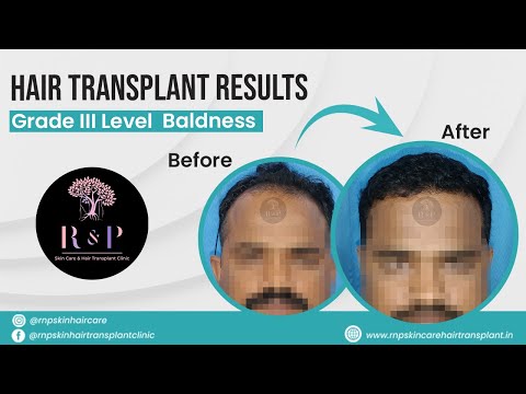 Treatment result video thumbnail