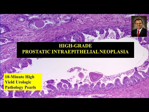 Normal prostate volume ultrasound in cc