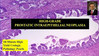 Download Lagu High-grade prostatic intraepithelial neoplasia (HGPIN) Thumbnail