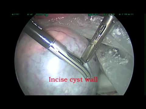 Laparoscopic Cross BagTechnique for Ovarian Cysts