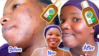 HOW TO USE DETTOL ANTISEPTIC LIQUID TO TREAT PIMPLES / ACNE, DARK SPOTS, SCARS & HYPERPIGMENTATION.